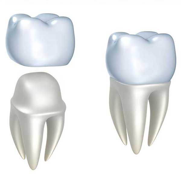 Dental Crowns | Montgomery Dental Centre | NW Calgary | Family and General Dentist