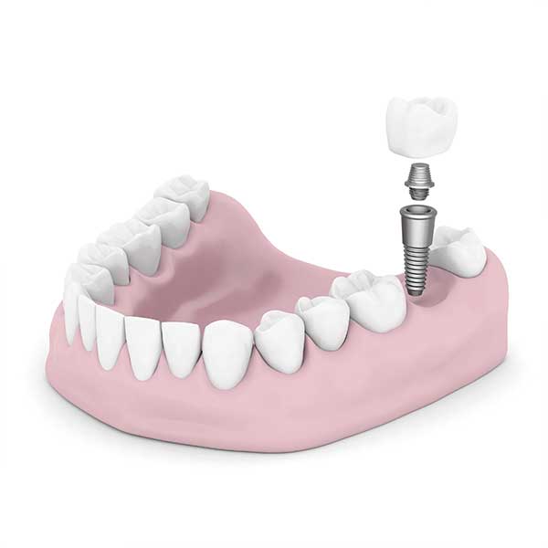 Dental Implants | Montgomery Dental Centre | NW Calgary | Family and General Dentist