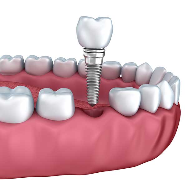 Dental Implants | Montgomery Dental Centre | NW Calgary | Family and General Dentist