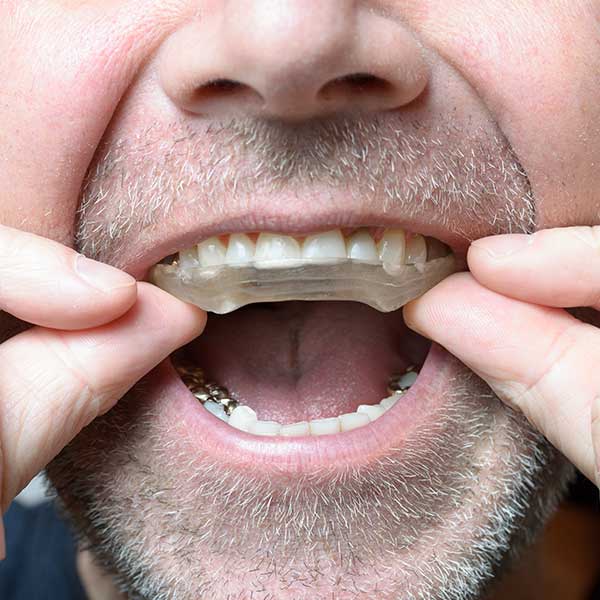 Bruxism Grinding Appliances | Montgomery Dental Centre | NW Calgary | Family and General Dentist