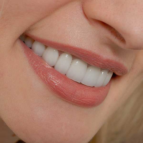 Porcelain Veneers | Montgomery Dental Centre | NW Calgary | Family and General Dentist