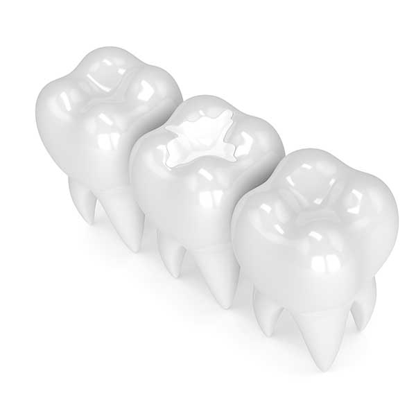 White Filling | Montgomery Dental Centre | NW Calgary | Family and General Dentist