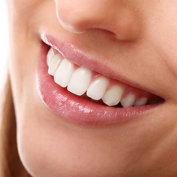 Teeth Whitening | Montgomery Dental Centre | NW Calgary | Family and General Dentist