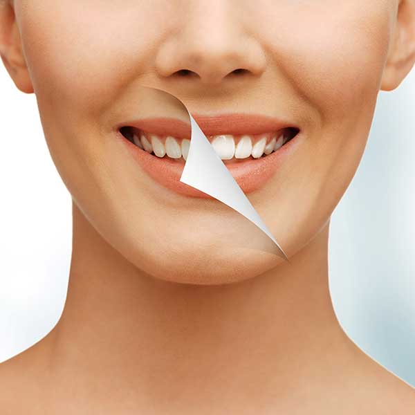Teeth Whitening | Montgomery Dental Centre | NW Calgary | Family and General Dentist