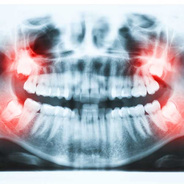 Wisdom Teeth Removal | Montgomery Dental Centre | NW Calgary | Family and General Dentist